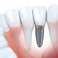 Dental Implants, Dentist West Kelowna